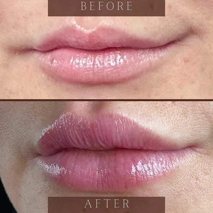 LipsByJoe aesthetic lip augmentation results