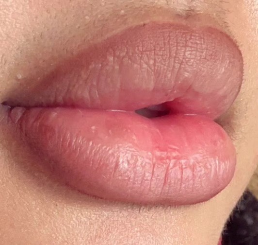 LipsByJoe lip filler patient results