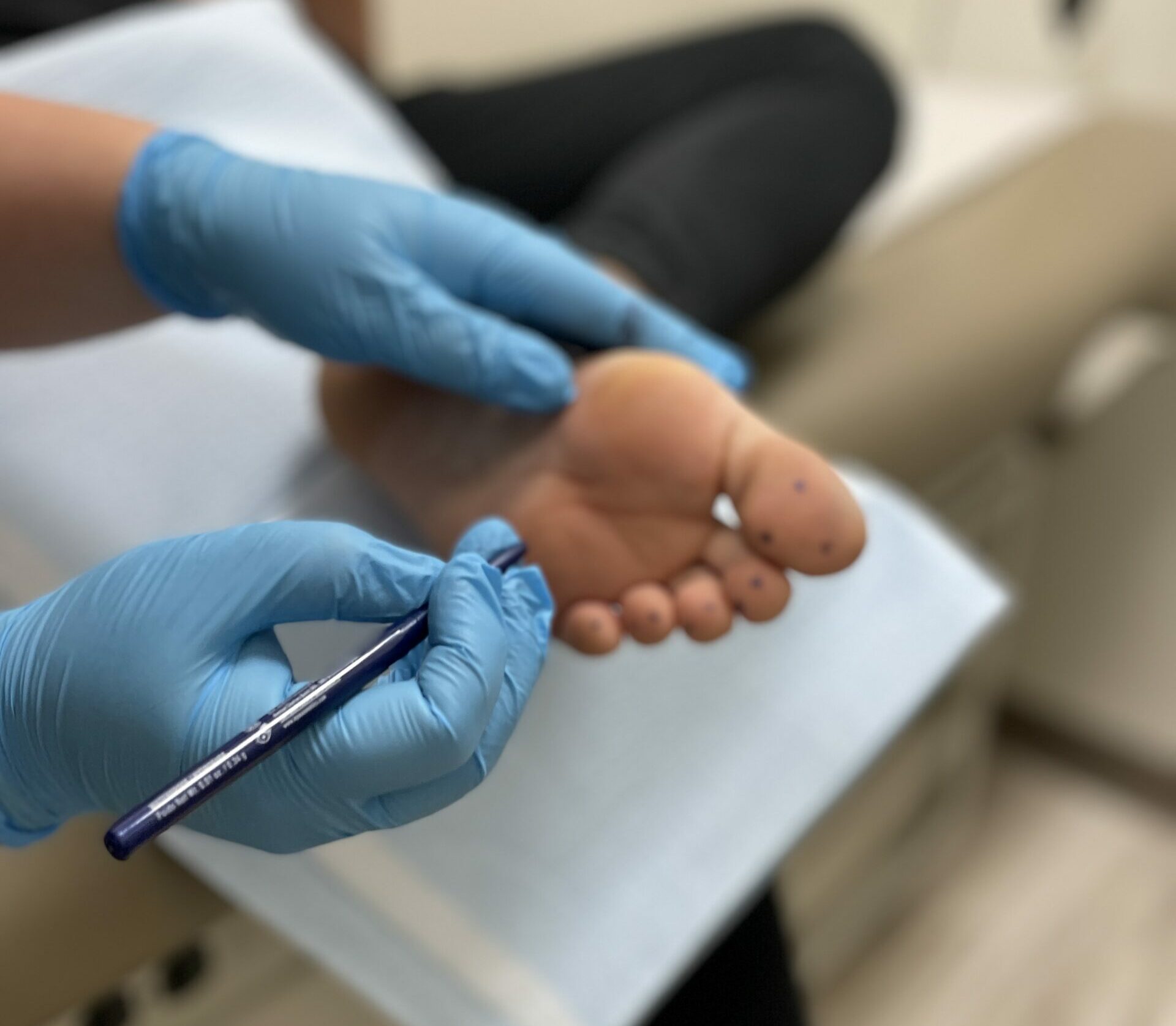 Hyperhidrosis excessive sweating treatment