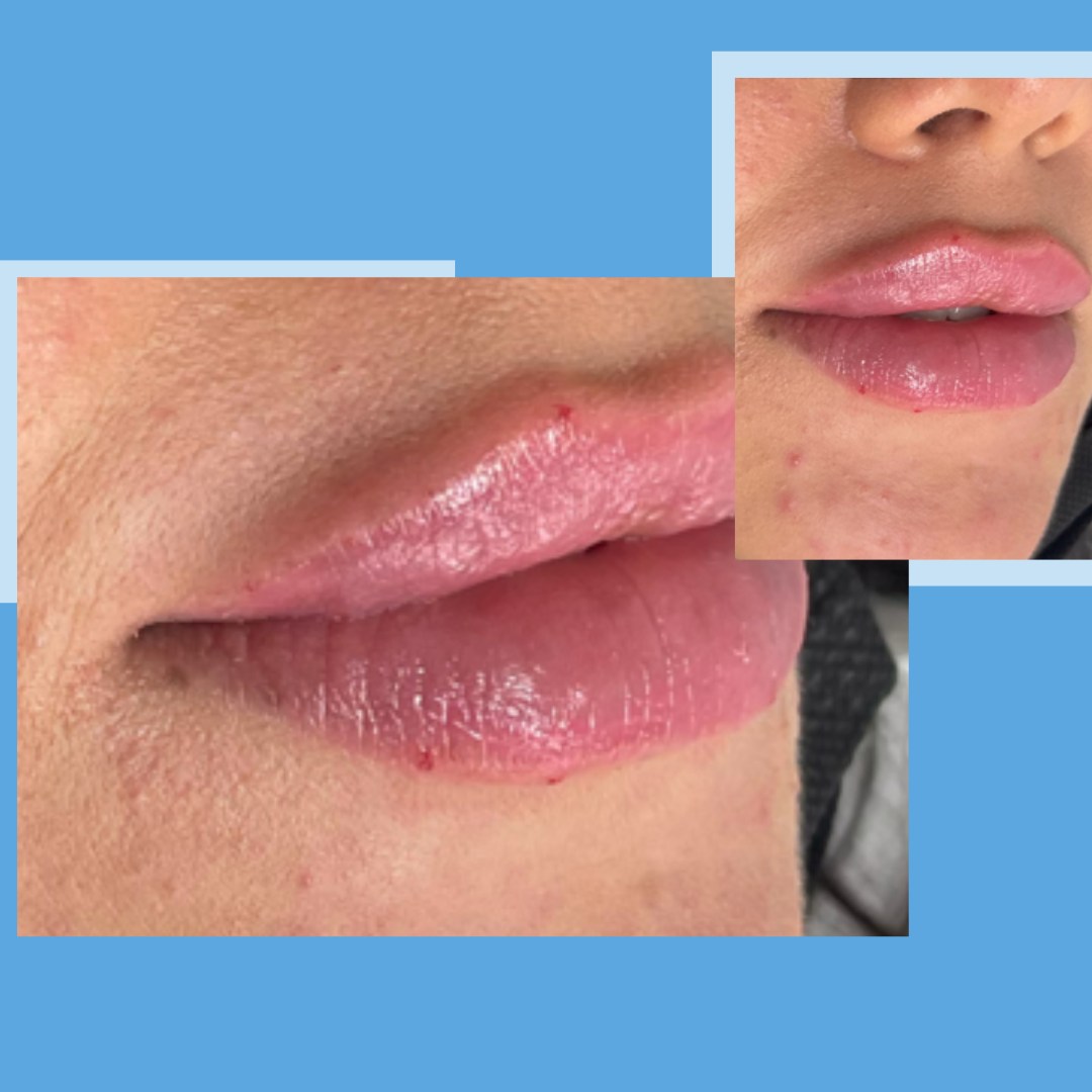 Lip filler treatment