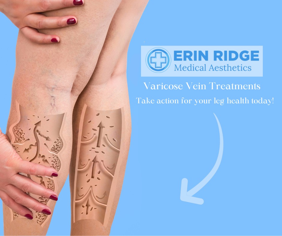 Varicose vein sclerotherapy treatment