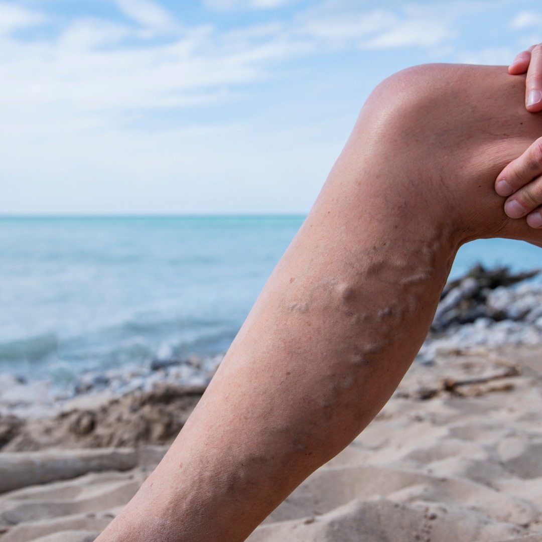 Varicose vein sclerotherapy treatment